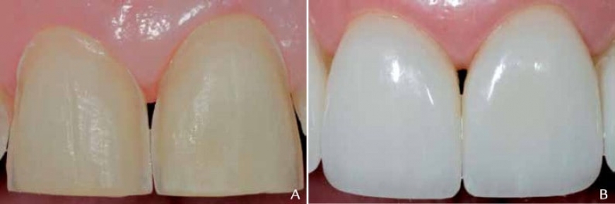 تفاوت کامپوزیت دندان و لمینت سرامیکی چیست؟ | شماره دندانپزشکان تبریز