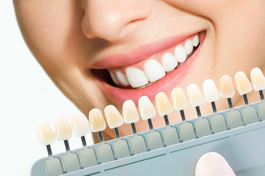 عوارض لمینت دندان + لیست دندانپزشکان تبریز