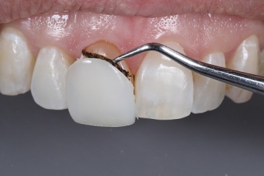 کامپوزیت دندان چیست؟ | لیست دندانپزشکان تبریز