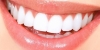 لمینت دیجیتال چیست ؟ لیست دندانپزشکان تبریز